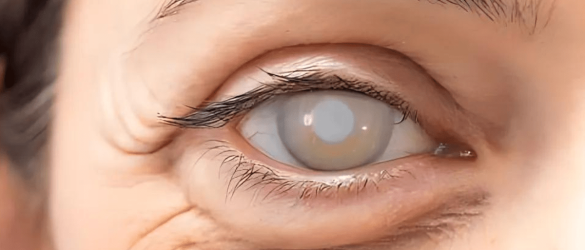 Eyes affected with cataract